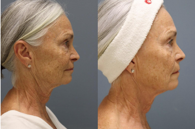 before and after - Premier Med Spa at Richardson, TX