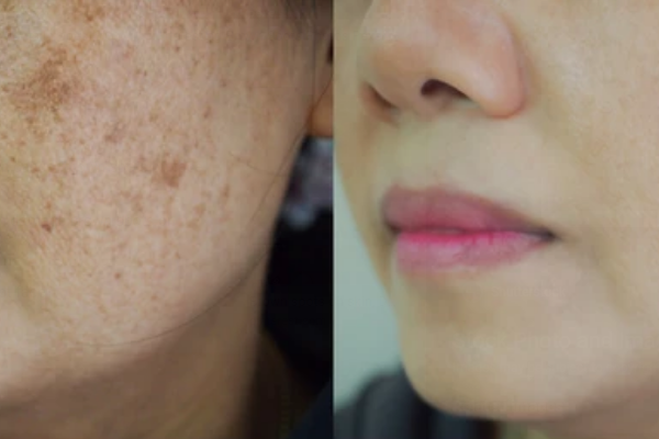 before & after brown_spots_gone Premier Med Spa at Richardson, TX