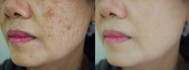 before & after brown_spots_gone Premier Med Spa at Richardson, TX