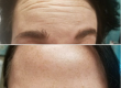 Forehead Wrinkles & Fine Lines before & after treatment | Premier Medspa in Richardson Texas