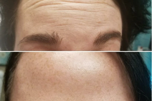 Forehead Wrinkles & Fine Lines before & after treatment | Premier Medspa in Richardson Texas