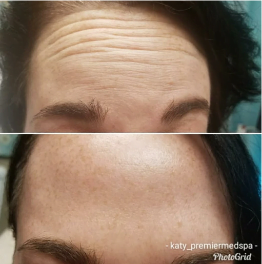 Forehead Wrinkles & Fine Lines before & after treatment | Premier Medspa in Richardson Texas