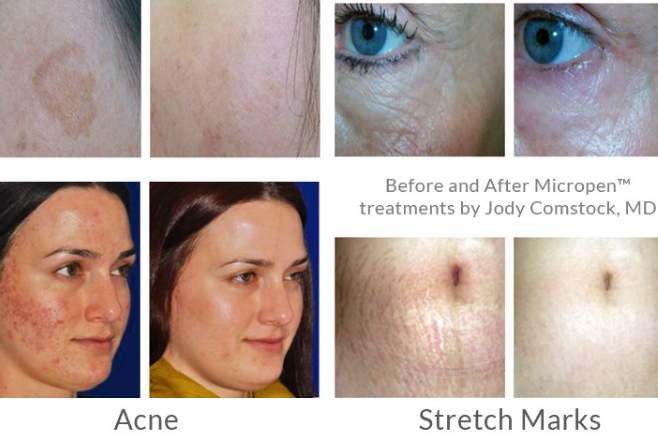 before & after rejuvenating-skin-treatments - Premier Med Spa at Richardson, TX