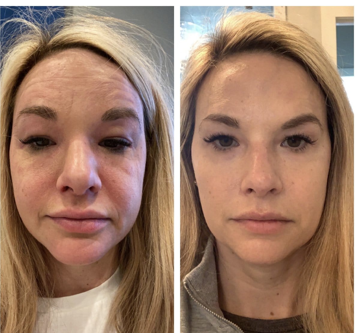 Before and After healing | Richardson, TX | Premier Med Spa