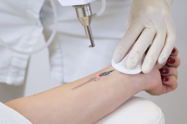 Pros and Cons of Tattoo Removal What You Need to Know