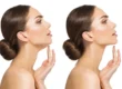 Kybella Treatment by Premier Medspa in Texas