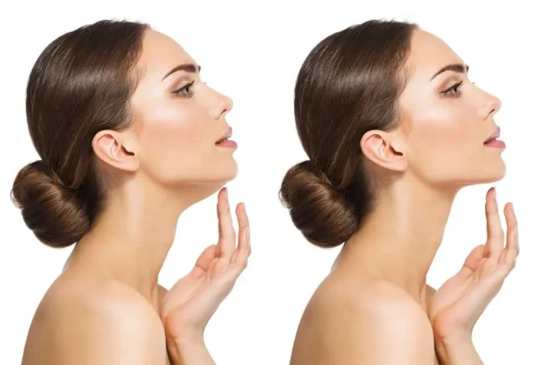 Kybella Treatment by Premier Medspa in Texas