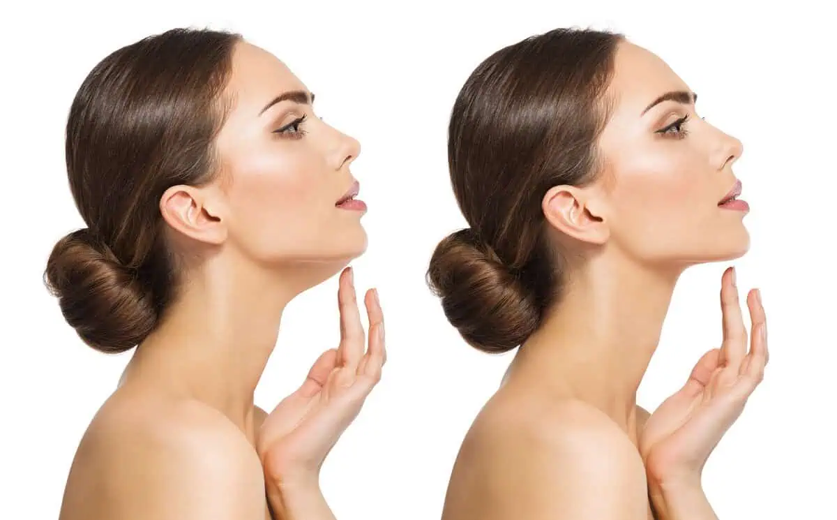 Kybella Treatment by Premier Medspa in Texas