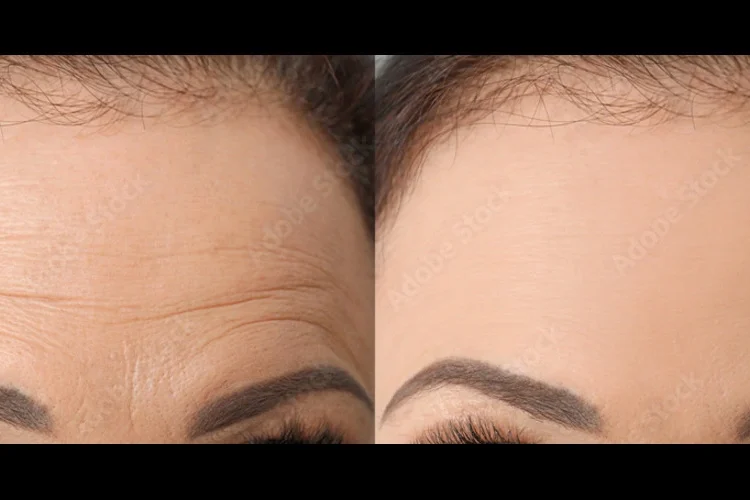 Botox and Dysport Treatment on Forehead | Premier Medspa in Texas