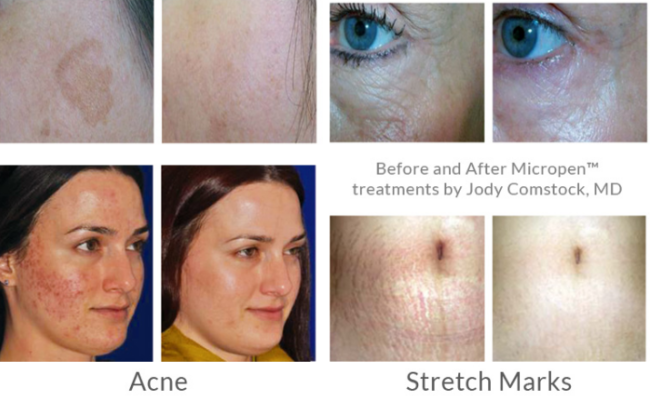 before & after rejuvenating-skin-treatments - Premier Med Spa at Richardson, TX