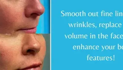 Filler Specials | before & after treatment images | Premier Medspa