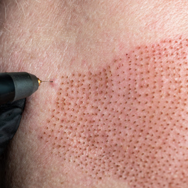 What You Need To Know About Plasma Pen